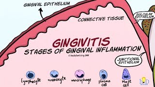 Gingivitis Stages of Gingival Inflammation [upl. by Annemarie301]