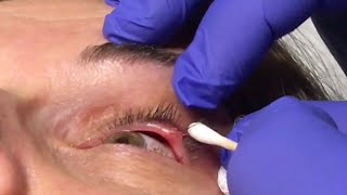 Surgeon Drains Stye On Womans Eye [upl. by Ellenig]