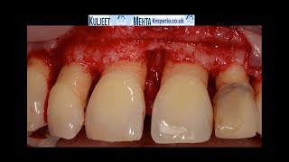 Periodontal Surgery Upper Front Teeth [upl. by Berstine]