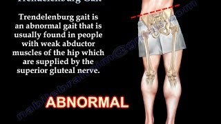 Trendelenburg Gait  Everything You Need To Know  Dr Nabil Ebraheim [upl. by Sharline155]