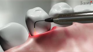 TwinLight® Periodontal Treatment [upl. by Helyn]