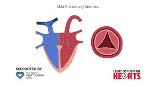 Pulmonary Stenosis [upl. by Anneh428]