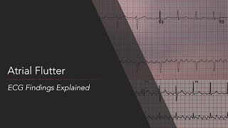 Atrial Flutter ECG Findings Explained [upl. by Ynaitirb525]