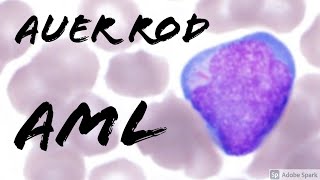 Acute Myeloid Leukemia Auer Rod in a Blast on Peripheral Blood Smear Hematopathology amp Hematology [upl. by Jaycee779]