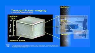 A CuttingEdge Treatment for Cornea Damage audiodescribed version [upl. by Anneis]