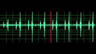 Pulmonary Associated Heart Sounds PAH Split S2 [upl. by Odnomar]