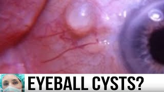 Eye Cyst Removal  Conjunctival Inclusion Cyst [upl. by Davidoff]