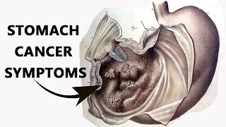 Mayo Clinic explains stomach cancer [upl. by Maxi]