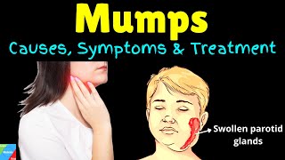 Mumps  Parotitis  Pathology  Introduction pathogenesis clinical feature diagnosis treatment [upl. by Laemsi]