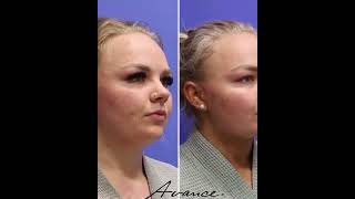 Reno NV Neck Liposuction with FaceTite  Neck Lipo Before amp After  Avance Plastic Surgery Institute [upl. by Pasho]