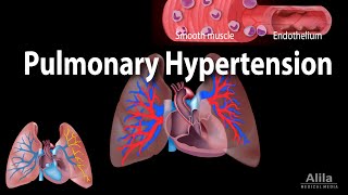 Pulmonary Hypertension Animation [upl. by Kellina109]