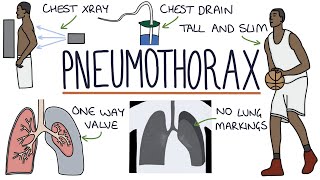 Pneumothorax [upl. by Redep]