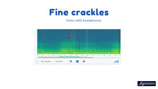 Lung sounds  fine crackles [upl. by Siul]