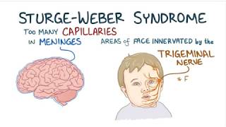 sturgeweber syndrome [upl. by Aven551]