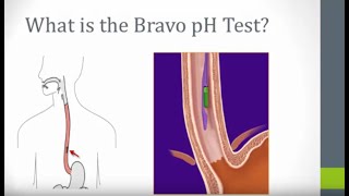 Your Bravo pH Test Experience [upl. by Nylcoj545]