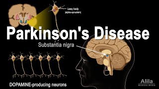 Understanding Parkinson’s Disease [upl. by Felipe]