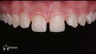 Smile makeover with direct veneers and simple managment of multiple diastema [upl. by Eudosia430]