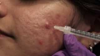 Watch amp Learn Intralesional injections [upl. by Ecinom29]