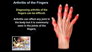 Arthritis Of The Fingers  Everything You Need To Know  Dr Nabil Ebraheim [upl. by Humo]