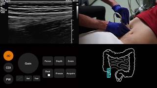 Ultrasound Tutorial AppendixAppendicitis  Radiology Nation [upl. by Amrac]