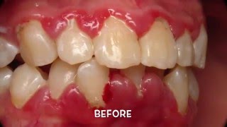 Treatment of Periodontal Gum Disease [upl. by Odlaw]