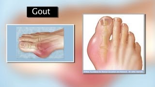 Gout and Turmeric [upl. by Samled]