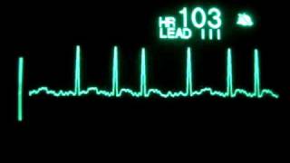 Atrial Fibrillation [upl. by Obara]