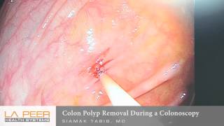 Colon Polyp Removal During Colonoscopy  Los Angeles La Peer Surgery Center [upl. by Ivens]