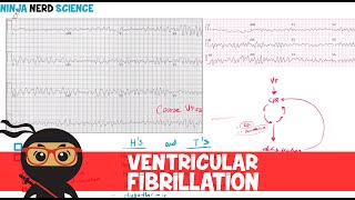 Intro to EKG Interpretation  Chamber Enlargement [upl. by Irmo35]