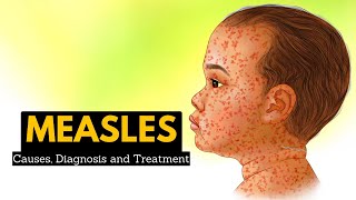 Mumps Signs and symptoms diagnosis treatment complications [upl. by Ennairak]