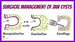 ORAL SURGERY  ENUCLEATION AFTER MARSUPIALIZATION [upl. by Beesley319]