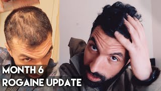 6 Month Rogaine Results Minoxidil [upl. by Sandstrom]