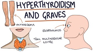 Understanding Hyperthyroidism and Graves Disease [upl. by Menon]