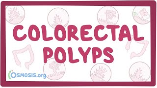 Colorectal polyps  an Osmosis Preview [upl. by Euqirdor167]