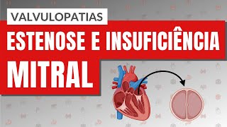 VALVULOPATIAS I PARTE 3 Estenose e Insuficiência mitral [upl. by Notnilk]