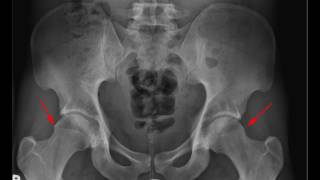 Femoroacetabular Impingement [upl. by Arleta972]