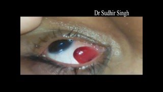 Conjunctival Pyogenic Granuloma Excision Video Under Topical Anesthesia 122 [upl. by Digdirb]