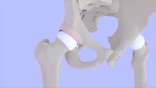 Femoroacetabular Impingement Syndrome [upl. by Asreht]