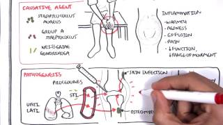 Septic Arthritis  Overview causes pathophysiology treatment [upl. by Ennayt]