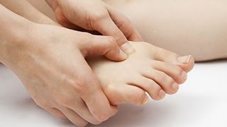 How to Cure a Gout Attack what works for me [upl. by Adnohsat17]