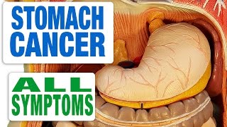 Stomach Cancer  All Symptoms [upl. by Giliane]