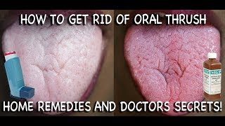 How to Treat Candida at Home Doctors Advice [upl. by Ribal]