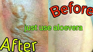 Treatment of Aloevera on burned skin [upl. by Mercola]