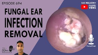 694  Fungal Ear Infection Removal [upl. by Ahmar]