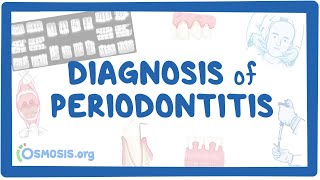 Diagnosis of Periodontitis [upl. by Halette]