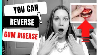 How to Reverse Gum Disease at Home [upl. by Enoitna]