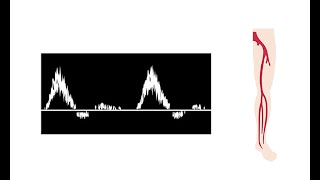 Interpreting duplex waveforms [upl. by Mcintyre706]