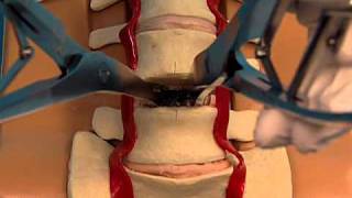 Synthes Spine ProDiscL Lumbar Total Disc Replacement Demonstration Video [upl. by Diaz]