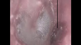 EAR INFECTION DISCHARGE REMOVED FROM BOTH EARS   444 [upl. by Auoz233]