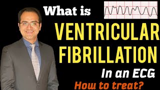 Understanding Ventricular Fibrillation How It Affects the Heart [upl. by Emoryt173]